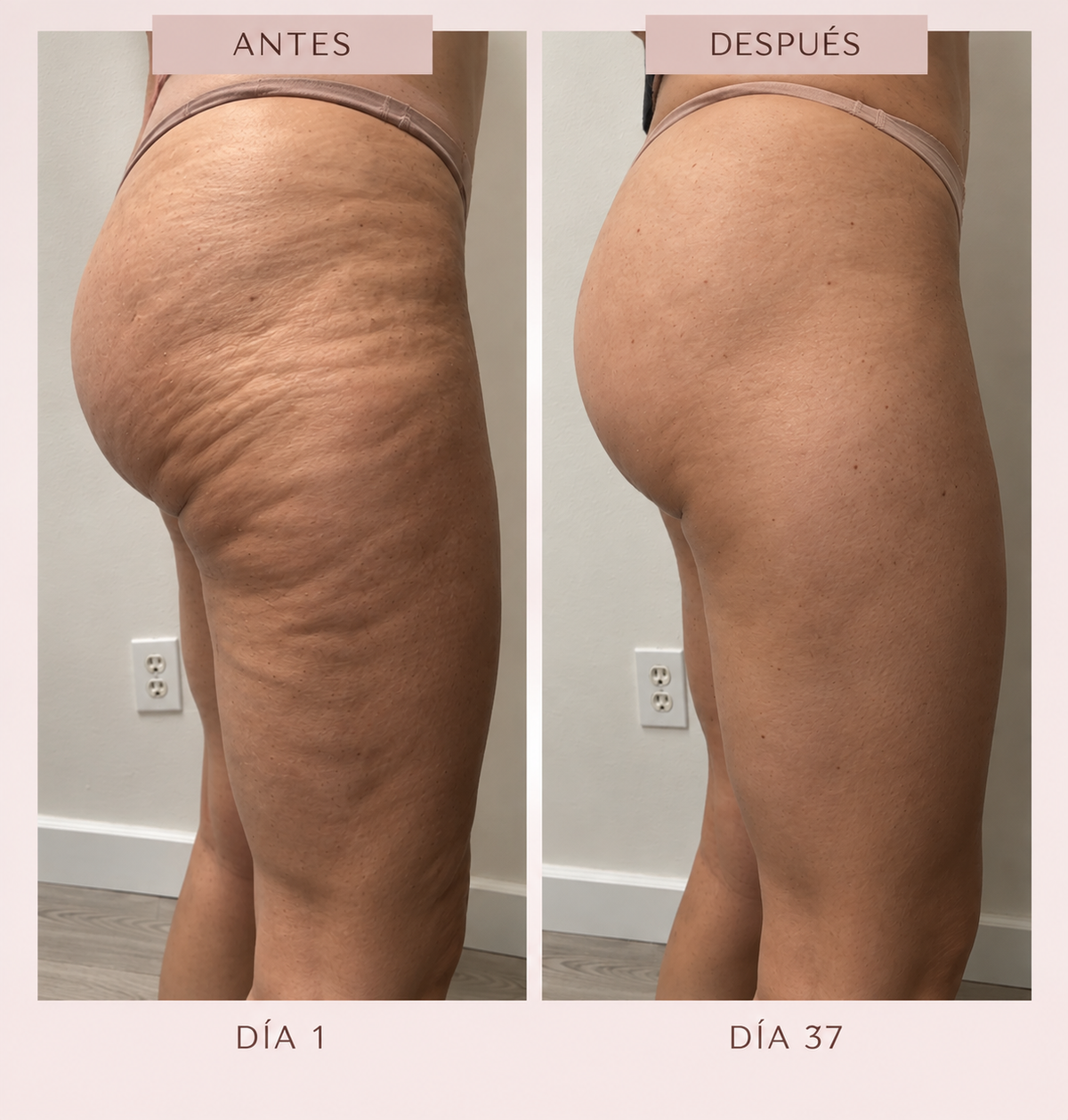 Masajeador AntiCelulitis Pro™